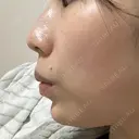 ボトックス（あご） / 肌ヒアルロン酸注入（たるみ・シワ改善） BIZENNクリニック【ビゼンクリニック】 DAY 8 サムネイル用