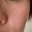 ピコレーザートーニング（美白・肝斑） 東京美容皮膚科アロエクリニック池袋 DAY 8 サムネイル用