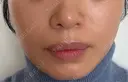 ピーリング（ニキビ・毛穴） Clara CLINIC 美容皮膚科・歯科 DAY 2 サムネイル用