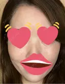 脂肪注入（肌） 日本ウェルネス再生クリニック DAY 3 サムネイル用