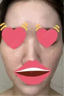 脂肪注入（肌） 日本ウェルネス再生クリニック DAY 5 サムネイル用