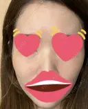 脂肪注入（肌） 日本ウェルネス再生クリニック DAY 6 サムネイル用