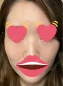 脂肪注入（肌） 日本ウェルネス再生クリニック DAY 7 サムネイル用