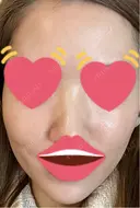 脂肪注入（肌） 日本ウェルネス再生クリニック DAY 8 サムネイル用