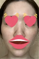 脂肪注入（肌） 日本ウェルネス再生クリニック DAY 9 サムネイル用