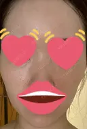 脂肪注入（肌） 日本ウェルネス再生クリニック AFTER サムネイル用