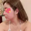 鼻尖形成（切開） / 鼻中隔延長（切開） / 脂肪注入（額） / 脂肪注入（輪郭） ビーザニュー美容整形外科（旧コノピ美容整形外科） DAY 57 サムネイル用