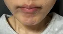 ボトックス（あご） / ボトックス（口角） / ボトックス（眉間） 上野注入クリニック DAY 0 サムネイル用