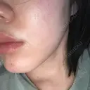医療脱毛（顔） 共立美容外科 立川院 DAY 1 サムネイル用