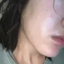 医療脱毛（顔） 共立美容外科 立川院 DAY 1 サムネイル用