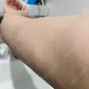 インディバ（二の腕） 渋谷美容外科クリニック 横浜院 DAY 8 サムネイル用
