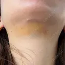 糸リフト / 脂肪吸引（顔） / 水光注射（ハリ・美肌） Wing clinic 豊中駅前院 DAY 7 サムネイル用