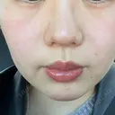 ピコレーザートーニング（美白・肝斑） 東京美容皮膚科アロエクリニック池袋 DAY 9 サムネイル用