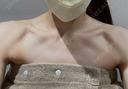 ボトックス（肩） BITO BEAUTY CLINIC DAY 0 サムネイル用