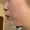 ボトックス（あご） / 肌ヒアルロン酸注入（たるみ・シワ改善） BIZENNクリニック【ビゼンクリニック】 DAY 11 サムネイル用