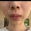ボトックス（あご） / 肌ヒアルロン酸注入（たるみ・シワ改善） BIZENNクリニック【ビゼンクリニック】 DAY 11 サムネイル用