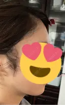 脂肪吸引（顔） / 下まぶたの脂肪取り 東京脂肪吸引クリニック DAY 68 サムネイル用