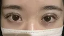 二重埋没 大塚美容形成外科 銀座本院 DAY 1 サムネイル用