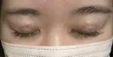 二重埋没 大塚美容形成外科 銀座本院 DAY 1 サムネイル用