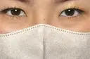二重埋没 / シワ取りボトックス RÉ CLINIQUE SENDAI DAY 7 サムネイル用