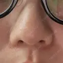 ピコレーザートーニング（美白・肝斑） 東京美容皮膚科アロエクリニック池袋 DAY 10 サムネイル用