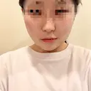 糸リフト / バッカルファット除去 / 脂肪吸引（顔） / ボトックス（あご） / ボトックス（エラ・小顔） アリエル美容クリニック 水戸院 DAY 6 サムネイル用