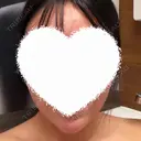 ヒアルロン酸注入（あご） Next Tokyo Clinic AFTER サムネイル用