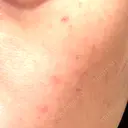 水光注射（ハリ・美肌） / 毛穴洗浄（ハイドラフェイシャルなど） RIN BEAUTY CLINIC DAY 7 サムネイル用