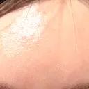 水光注射（ハリ・美肌） / 毛穴洗浄（ハイドラフェイシャルなど） RIN BEAUTY CLINIC DAY 7 サムネイル用