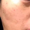 水光注射（ハリ・美肌） / 毛穴洗浄（ハイドラフェイシャルなど） RIN BEAUTY CLINIC DAY 7 サムネイル用