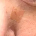 ほくろ・いぼ除去レーザー（肌） 心斎橋KT美容クリニック DAY 7 サムネイル用