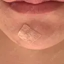 ほくろ・いぼ除去レーザー（肌） 心斎橋KT美容クリニック DAY 7 サムネイル用