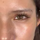 二重埋没 / 上まぶたの脂肪取り / 口角挙上 / ヒアルロン酸注入（涙袋） / ボトックス（エラ・小顔） / ヒアルロン酸注入（唇） / ボトックス（肩） アリエル美容クリニック 大宮院 DAY 7 サムネイル用