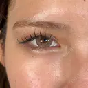 二重埋没 / 上まぶたの脂肪取り / 口角挙上 / ヒアルロン酸注入（涙袋） / ボトックス（エラ・小顔） / ヒアルロン酸注入（唇） / ボトックス（肩） アリエル美容クリニック 大宮院 DAY 44 サムネイル用