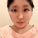 糸リフト / バッカルファット除去 / 脂肪吸引（顔） / ボトックス（あご） / ボトックス（エラ・小顔） アリエル美容クリニック 水戸院 DAY 7 サムネイル用