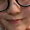 ピコレーザートーニング（美白・肝斑） 東京美容皮膚科アロエクリニック池袋 AFTER サムネイル用