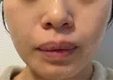 ピーリング（ニキビ・毛穴） Clara CLINIC 美容皮膚科・歯科 AFTER サムネイル用