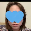 糸リフト / 脂肪吸引（顔） / ジョールファット除去 / 脂肪吸引注射（顔） SEA CLINIC（シークリニック） DAY 29 サムネイル用