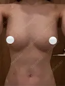 豊胸（脂肪注入） / マイクロボトックス ルーチェクリニック 銀座院 AFTER サムネイル用
