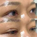 二重埋没 オジスキンクリニック DAY 4 サムネイル用