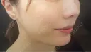 鼻翼基部形成（貴族手術） eクリニック 富山駅前院 AFTER サムネイル用
