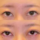 脂肪吸引（顔） / 目尻切開 / タレ目形成・グラマラスライン（埋没） LOUIS CLINIC 二子玉川院【ルイクリニック】 DAY 0 サムネイル用