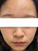イオン導入 / 光治療（フォトフェイシャルなど） / ルメッカ BITO BEAUTY CLINIC AFTER サムネイル用