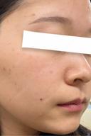 イオン導入 / 光治療（フォトフェイシャルなど） / ルメッカ BITO BEAUTY CLINIC DAY 0 サムネイル用