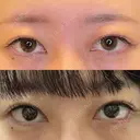 脂肪吸引（顔） / 目尻切開 / タレ目形成・グラマラスライン（埋没） LOUIS CLINIC 二子玉川院【ルイクリニック】 DAY 1 サムネイル用