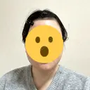 ボトックス（エラ・小顔） フィラークリニック 大阪心斎橋院 DAY 8 サムネイル用