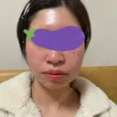 オンダリフト LIGHT CLINIC 【ライトクリニック】 名古屋院 AFTER サムネイル用