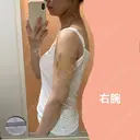 脂肪吸引（二の腕） ジョウクリニック 松山院 DAY 12 サムネイル用