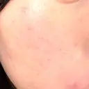 水光注射（ハリ・美肌） / 毛穴洗浄（ハイドラフェイシャルなど） RIN BEAUTY CLINIC AFTER サムネイル用