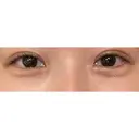二重切開 / 眼瞼下垂（切開） / 上まぶたたるみ取り eクリニック 福岡院 AFTER サムネイル用